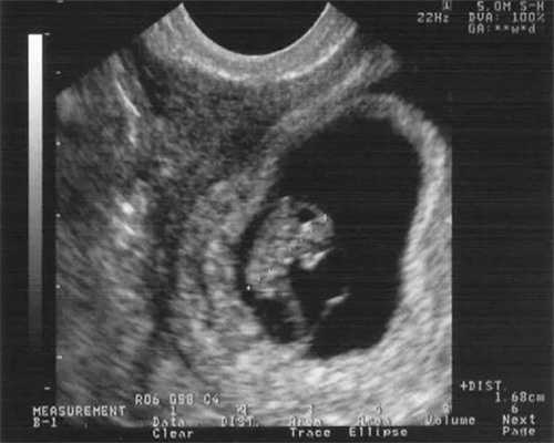 湖北单身借卵，武汉供卵借卵多少钱？