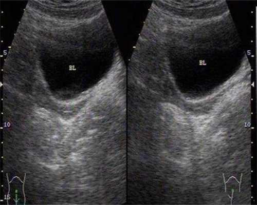 打破卵针后卵泡会萎缩吗